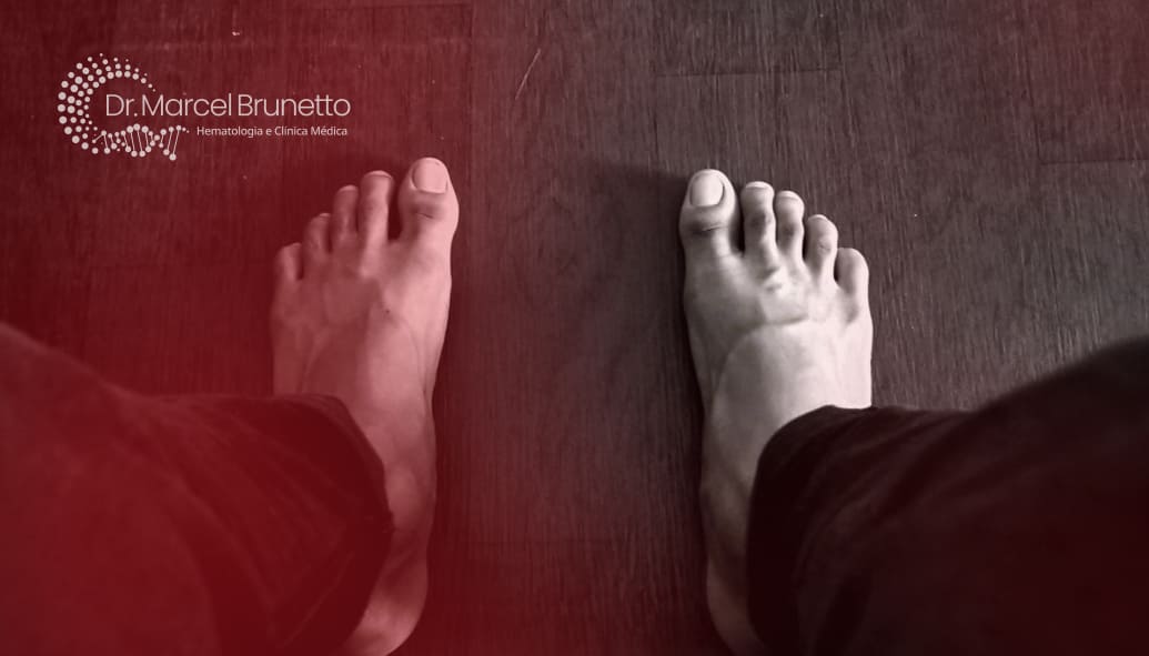 Neuropatia Periférica no Mieloma Múltiplo