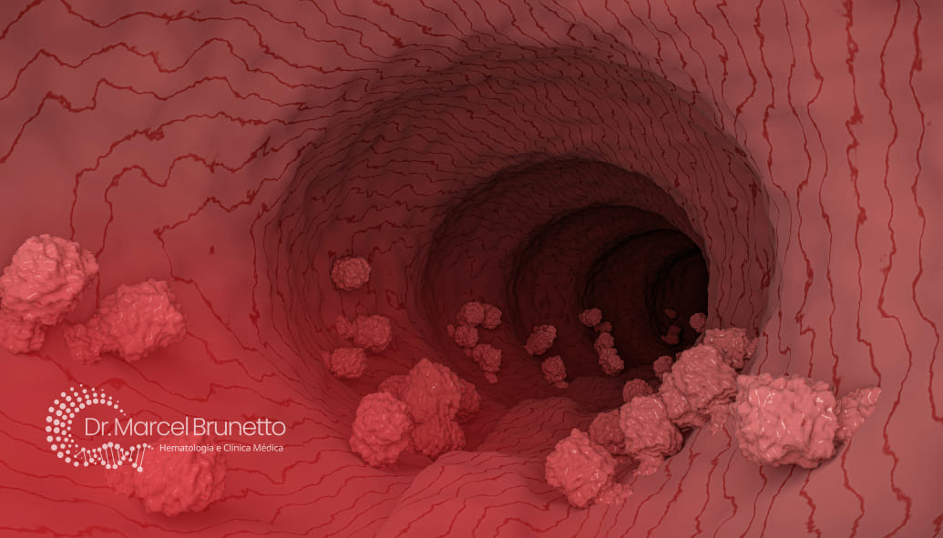 Leucemia Linfocítica Granular Grande